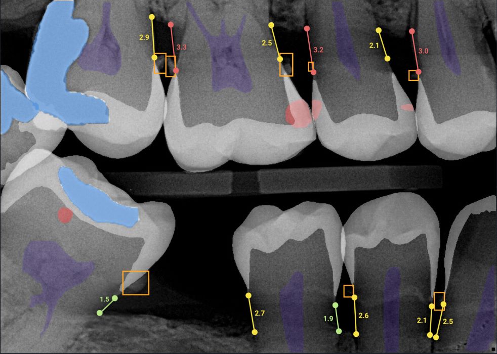 A monochrome dental X-ray with different tooth surfaces highlighted in bright pastel colors